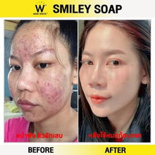 W Smiley Soap: Face Acne and Body Acne