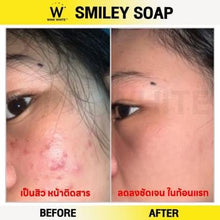 W Smiley Soap: Face Acne and Body Acne